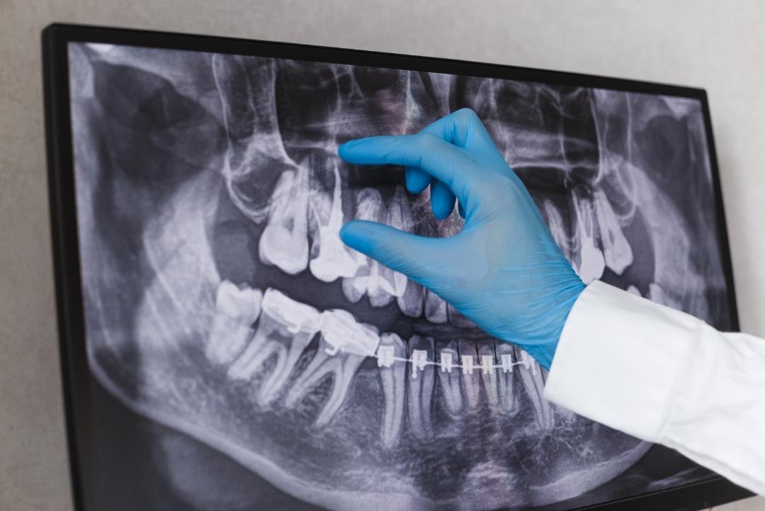 Dentist In Brampton Root Canal